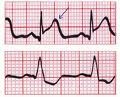 EKG ob infarktu